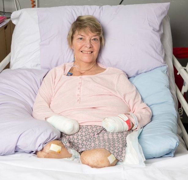 A smiling woman with amputated limbs and bandaged stumps rests in a hospital bed with pillows and bedding.