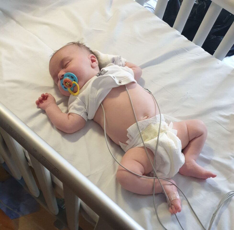 An infant sleeps on a white hospital bed sheet, shirtless, in a diaper, with a pacifier and medical wires attached to its body.